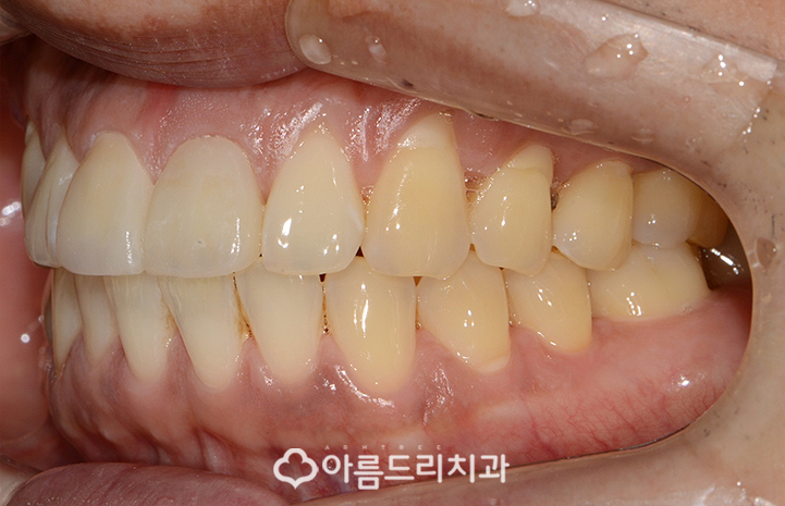 실활치미백 치은 잇몸퇴축 재생으로 동안치아 관련 이미지 10