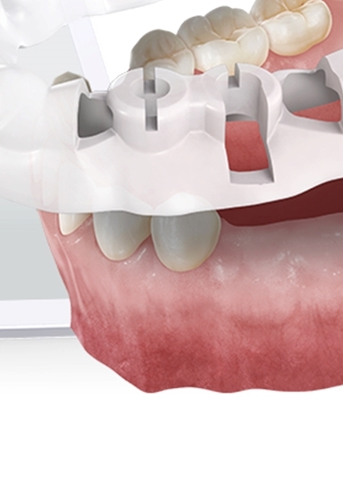 디지털임플란트 당일임플란트로 정확하고 안전하다면 관련 이미지 24