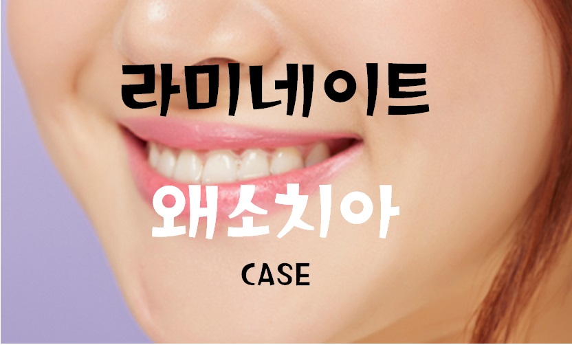 앞니 라미네이트_왜소치아 (최소삭제) 관련 이미지 1