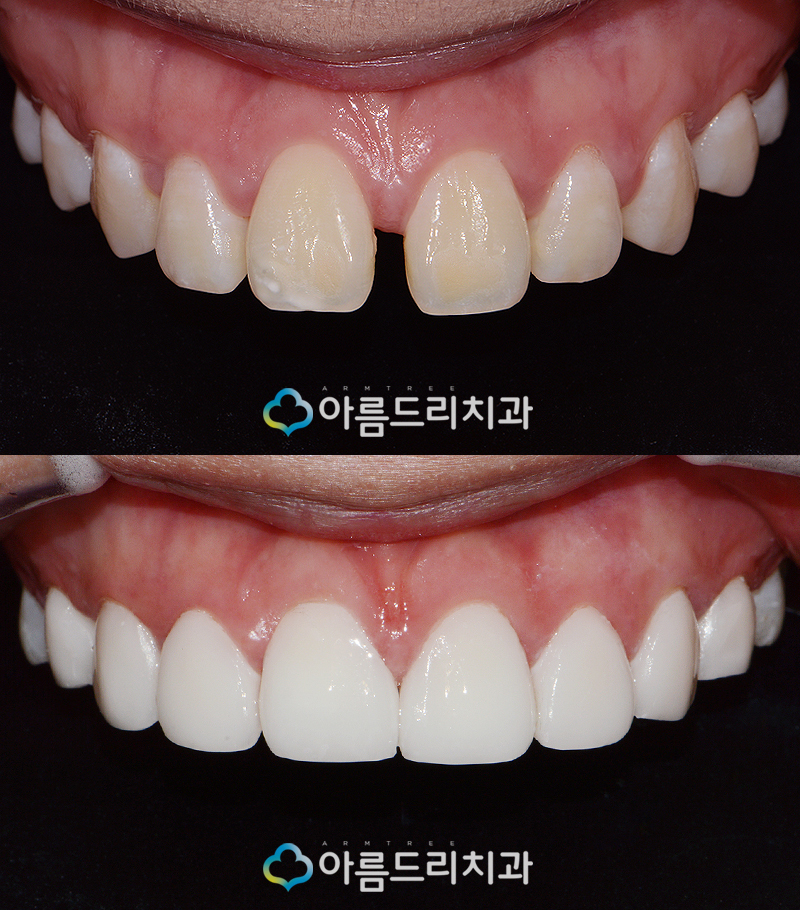 라미네이트부작용 걱정은노 관련 이미지 9