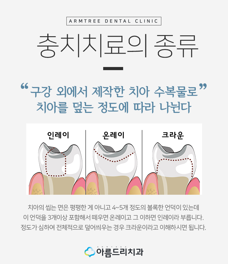충치인레이 아말감주변 충치치료는? 관련 이미지 7
