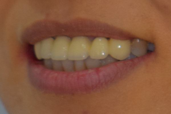 앞니 크라운 재치료 & 잇몸성형 _건강하게 . 예뻐지는 방법 관련 이미지 5