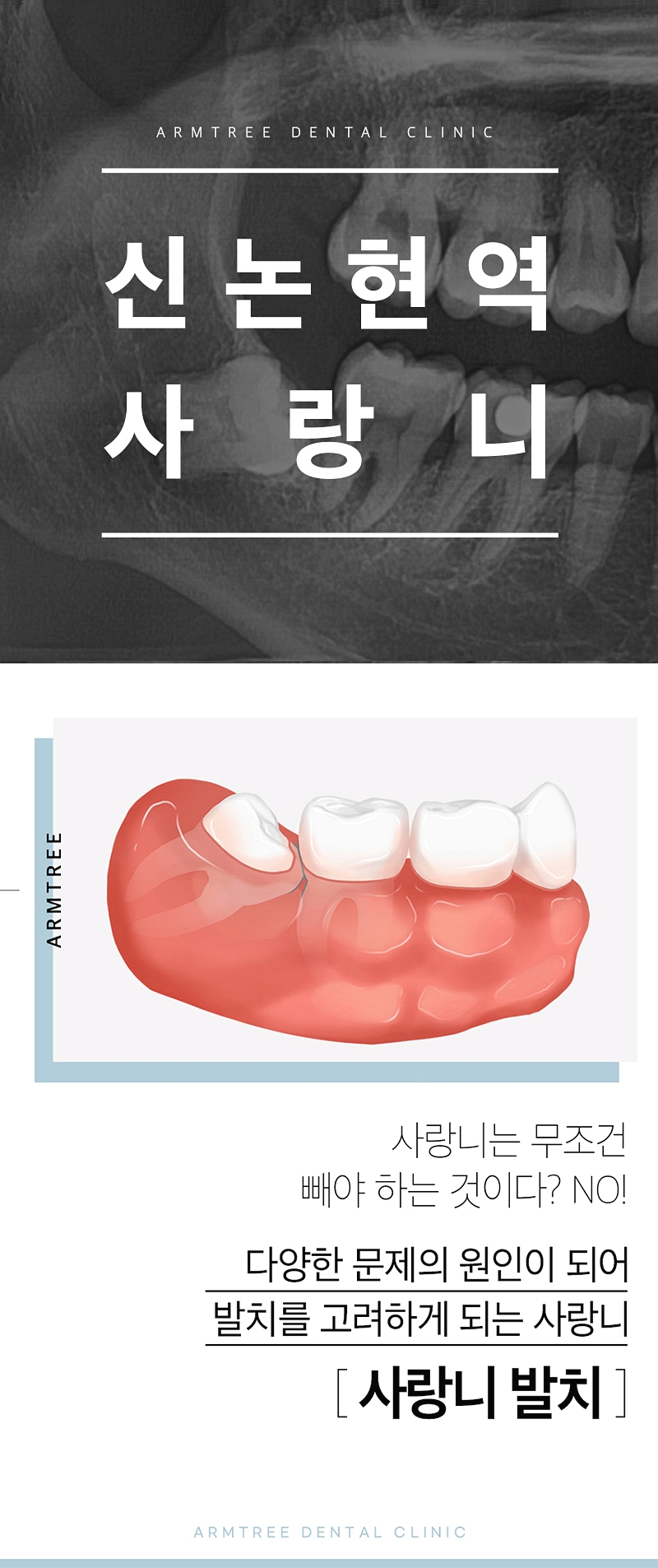 신논현역치과 사랑니 발치를 원한다면 관련 이미지 1