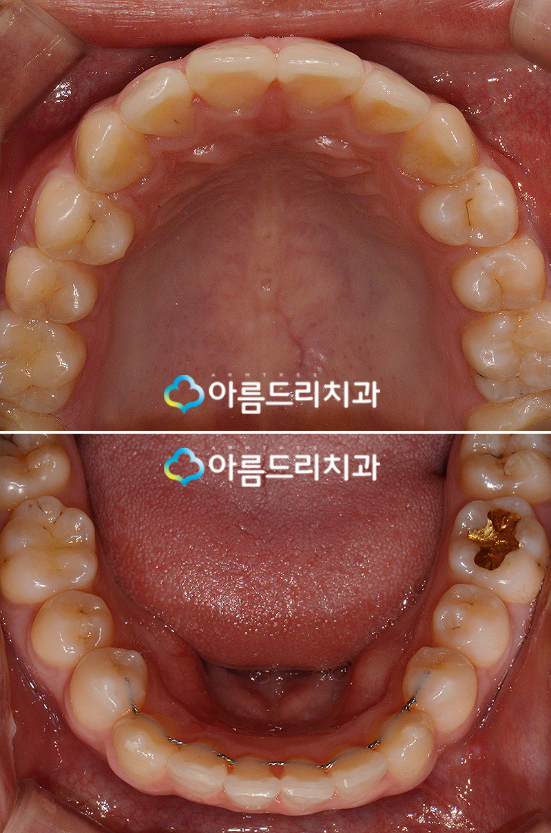 부분 설측교정비용 후기가 좋은 치과 관련 이미지 8