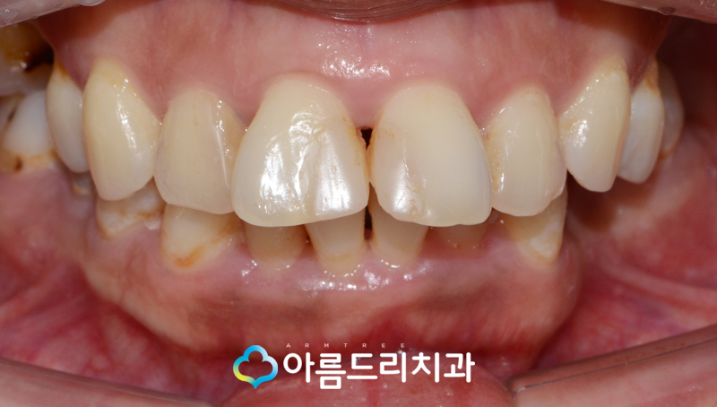 라미네이트연예인 이빨(치아) 최소삭제 이거다 관련 이미지 6