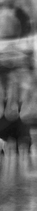 신논현역치과 사랑니 발치를 원한다면 관련 이미지 9