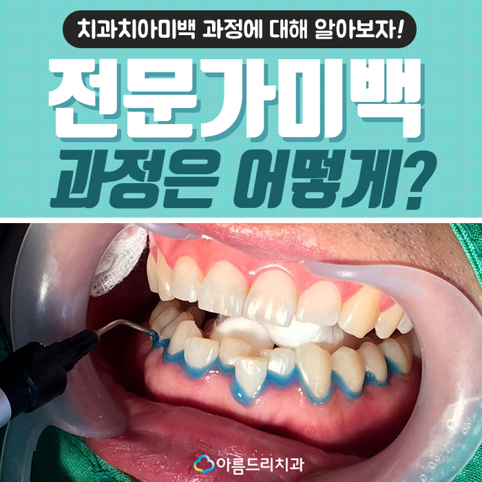 이빨미백 연예인치아미백 누런이 탈출 관련 이미지 1