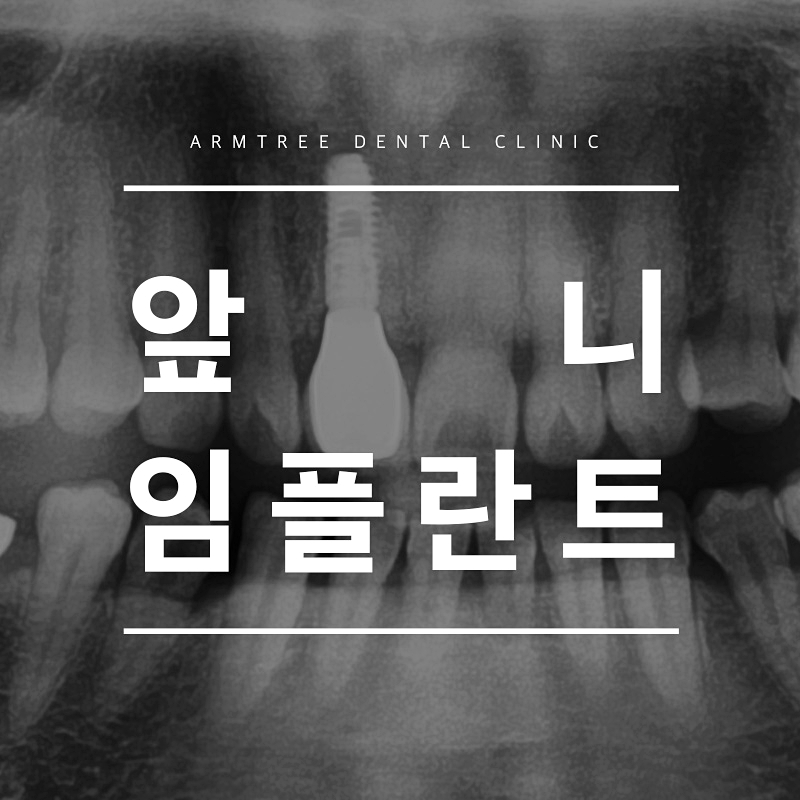 앞니임플란트 자연스러움을 원한다면 관련 이미지 1