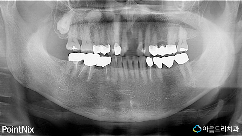 치아탈구(깨짐) 앞니임플란트 지르코니아어버트먼트 관련 이미지 3