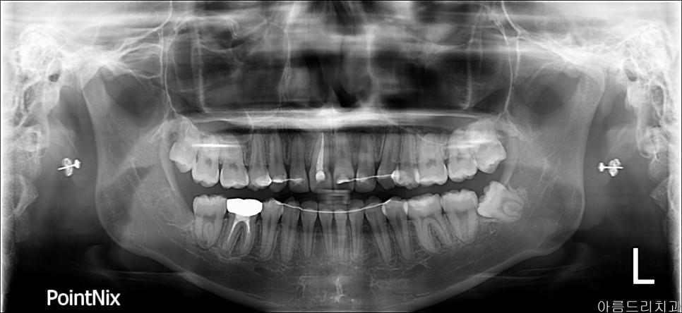 강남 아름드리치과 수술 발치_매복치 신논현치과 관련 이미지 5