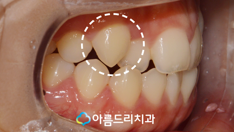 덧니부분교정 앞니 이런후기만 관련 이미지 4