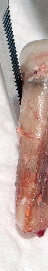 신논현치과 사랑니발치 치과는 신중하게 관련 이미지 9