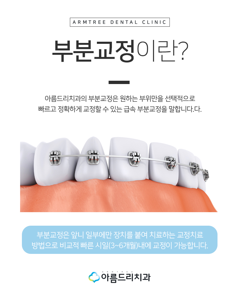 부분치아교정 앞니벌어짐 부분교정후기는! 관련 이미지 5