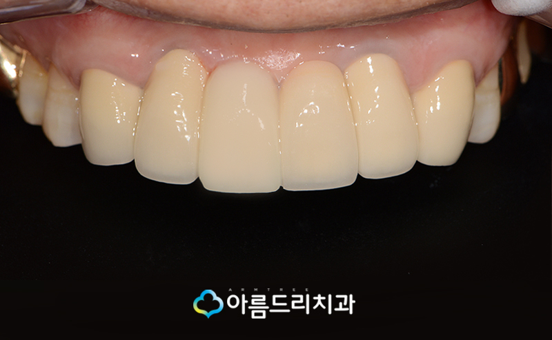 앞니 브릿지가 깨졌어요 치과치료 관련 이미지 9