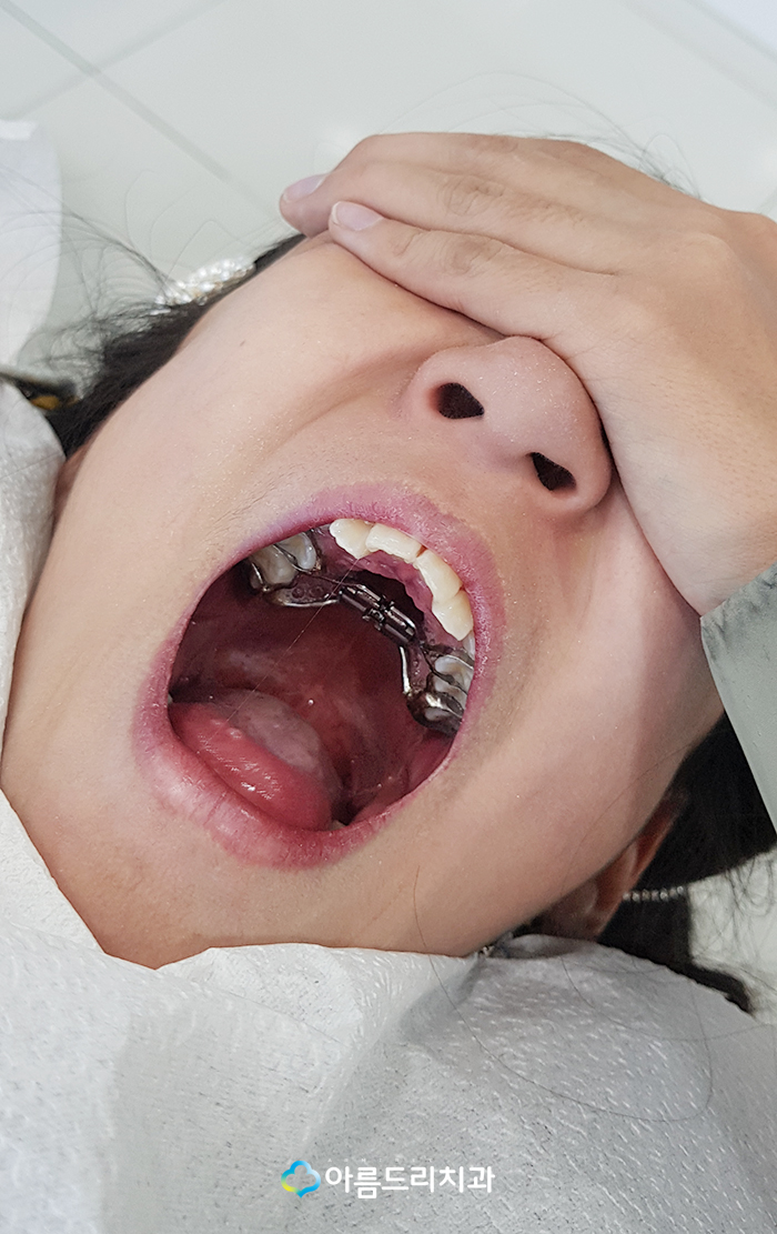 어린이 부정교합교정 RPE 악궁확장장치 관련 이미지 6
