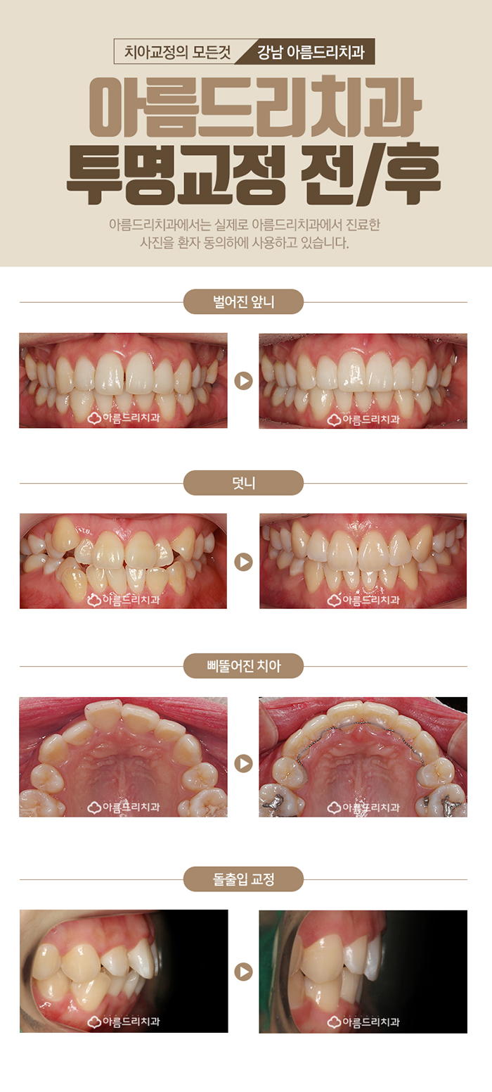 투명교정단점 통증 바로알자 관련 이미지 5