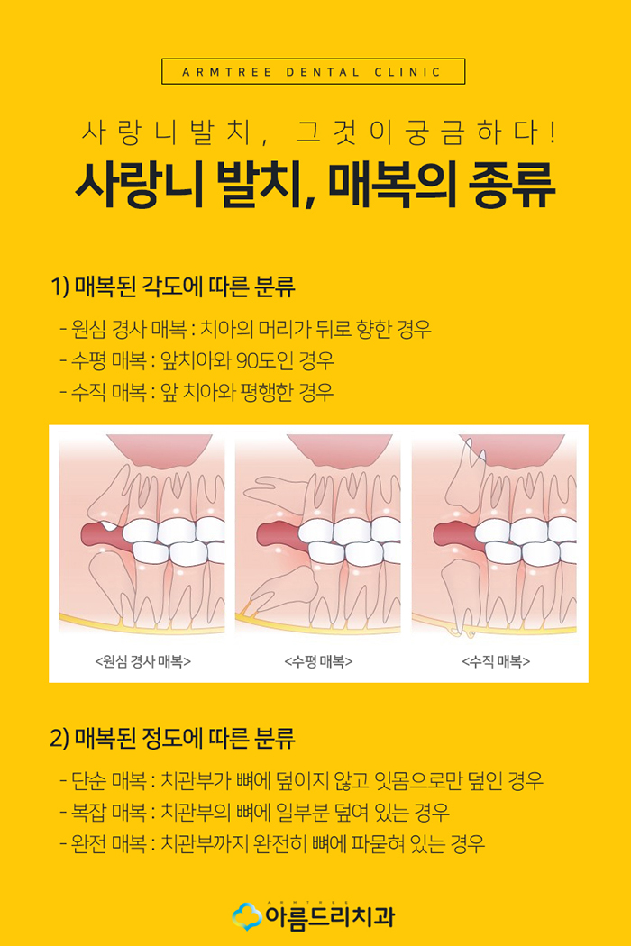 매복사랑니 발치 과정 주의사항 관련 이미지 3