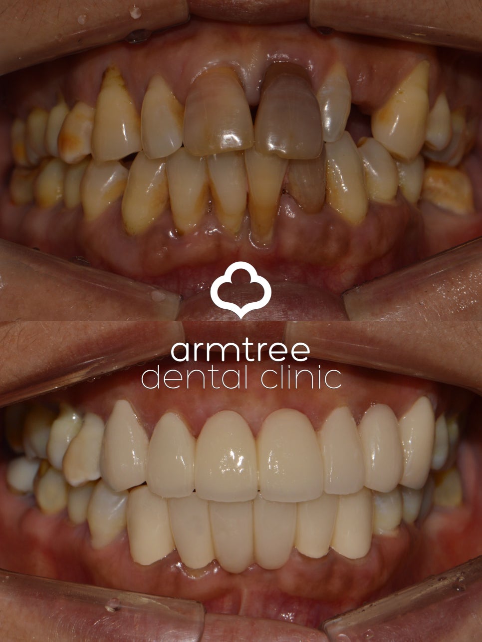 이현정원장의 아름다운 당신 시즌 2 (8회 윤해숙 도전자) 치주치료, 충치치료, 원데이 임플란트, 네비게이션 임플란트, 돌출입 심미보철, 치아미백, 스마일 트레이닝 관련 이미지 8