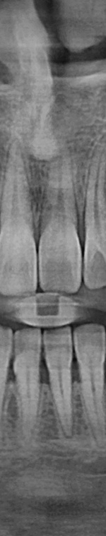 반포치과 사랑니발치 치과를 찾고있다면 관련 이미지 9