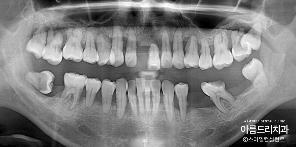 왜 임플란트와 치아교정을 다 잘아는 곳에서 치료해야할까?| 아름드리치과 진료일기 관련 이미지 1