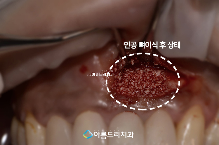 치근단절제술 후기로보는 완벽함 관련 이미지 8