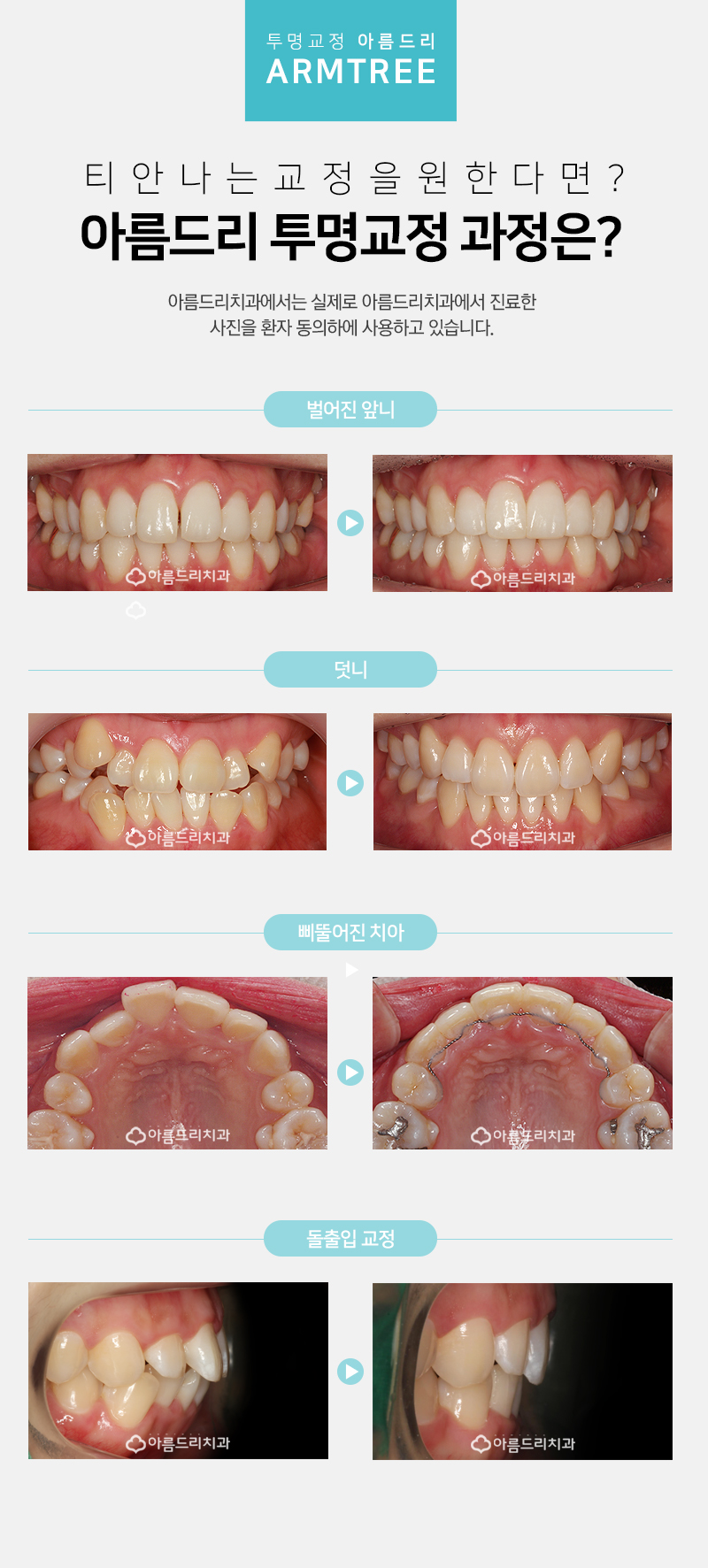 인비절라인교정 투명교정치과 통증은? 관련 이미지 8