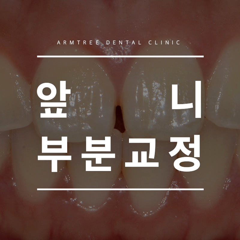 벌어진앞니교정 부분만 효과적으로 아름드리치과 관련 이미지 1