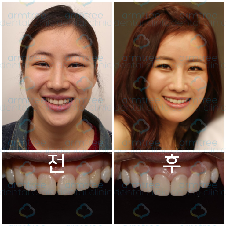 이현정 원장의 아름다운 당신 시즌 1 (9회 조혜진 도전자) 치아성형, 라미네이트, 치아미백, 화이트랩스 관련 이미지 6