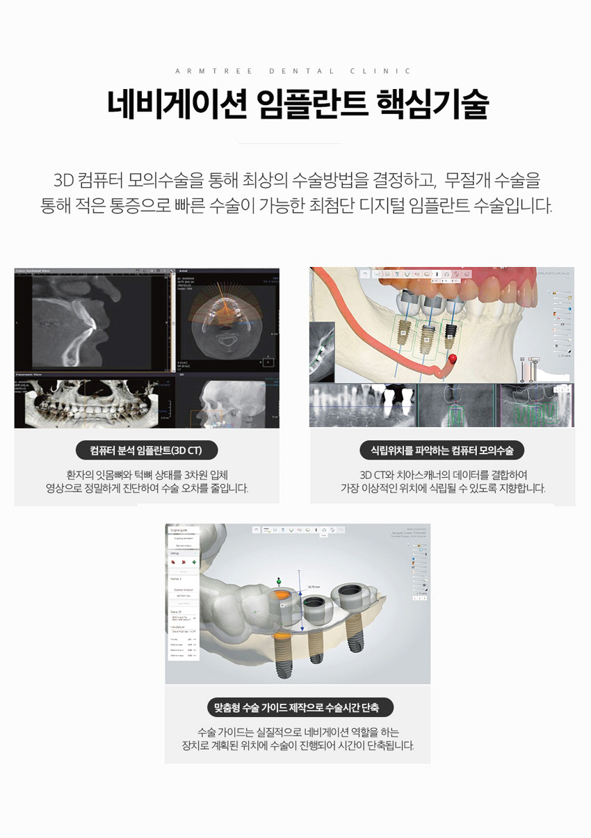 전체임플란트 전악임플란트 전후 아름드리치과 진료일기 관련 이미지 4