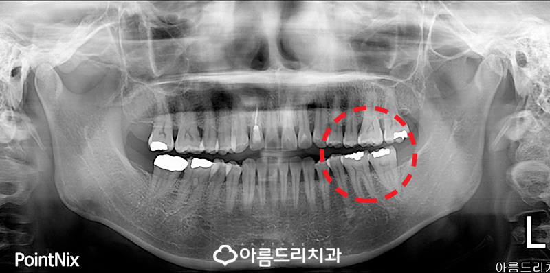 금니 2차충치 생기는 이유와 치료 관련 이미지 3
