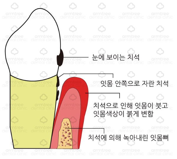 [치주 질환-1] 양치할 때마다 피가 난다?(아름드리 치아상식) 관련 이미지 3