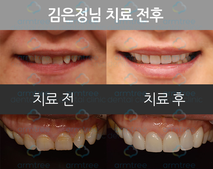 이현정 원장의 아름다운 당신 시즌 1 (11회 김은정 도전자) 치아성형, 올 세라믹, 급속교정, 임플란트, 내비게이션 임플란트 관련 이미지 2