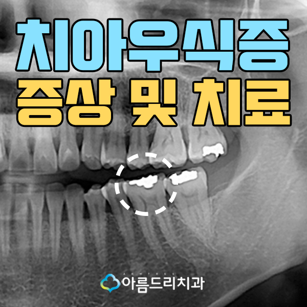 치아우식증 어금니충치 재충치치료 관련 이미지 1