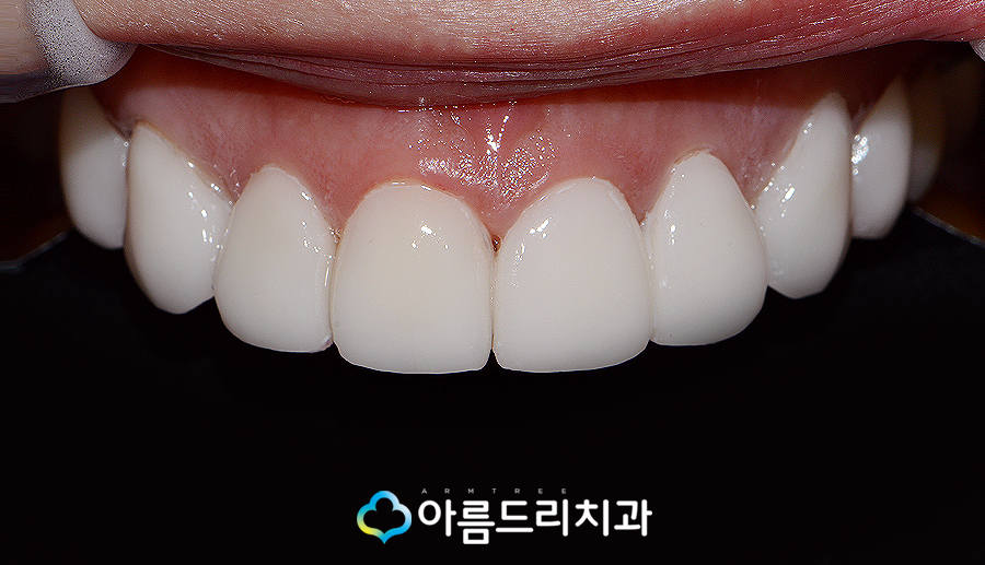 치아라미네이트 삭제량이 초중요 관련 이미지 8