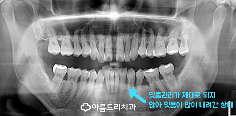 부분교정치과 후기 성인치주교정 관련 이미지 3