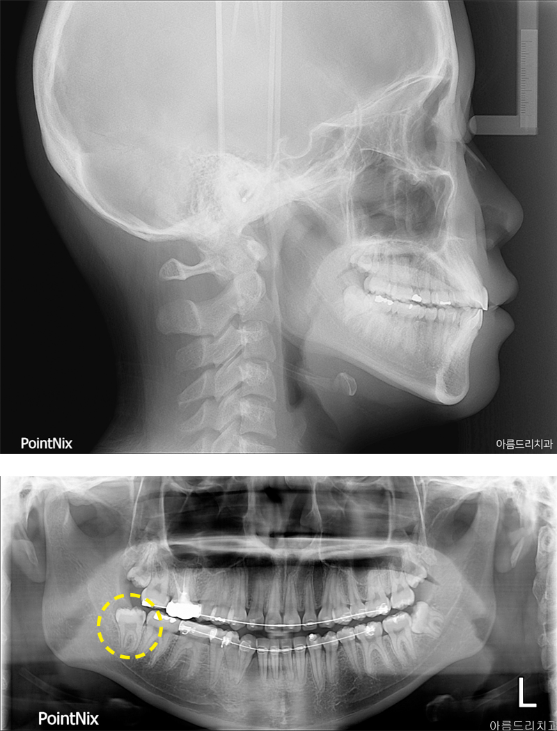 매복사랑니발치 후기 비용 아름드리치과 관련 이미지 4