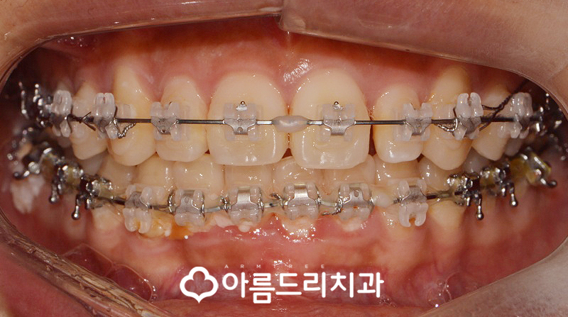 급속치아교정 코티코토미 피질골절단술 후기 관련 이미지 9