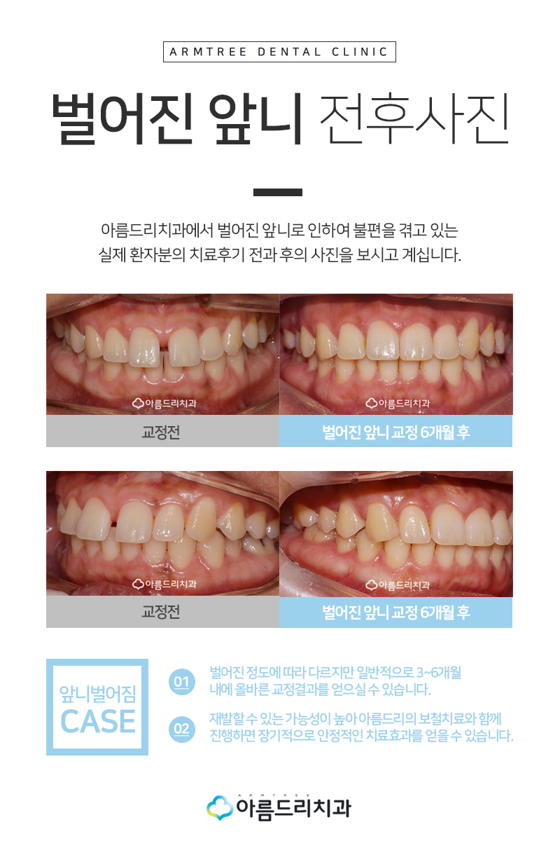부분치아교정 앞니벌어짐 부분교정후기는! 관련 이미지 7