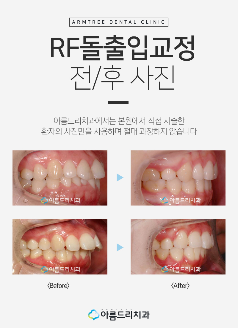 돌출입교정후기 급속으로 입툭튀 안녕 관련 이미지 7