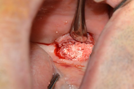 부분교정+임플란트(진료일기) 관련 이미지 7