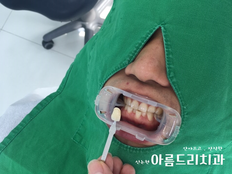신논현역치과 아름드리치과에서 건강한 치아미백, 전문가 미백 관련 이미지 5