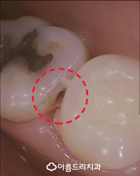 충치인레이 아말감주변 충치치료는? 관련 이미지 5