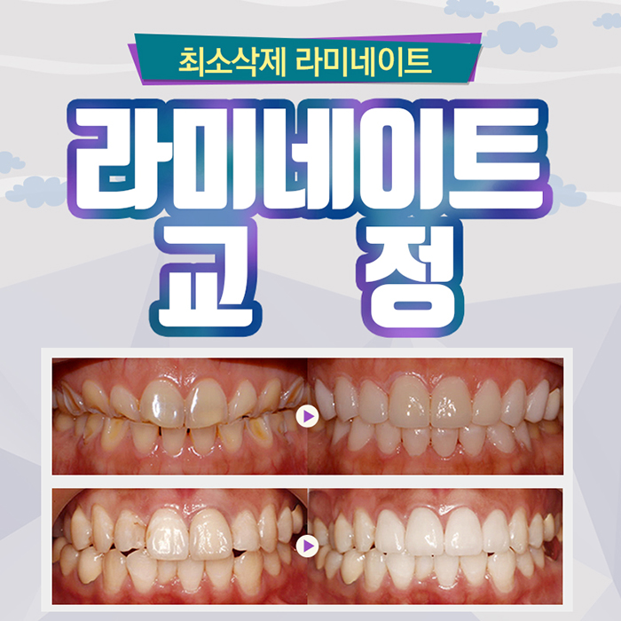 라미네이트교정 더이상 속지마 관련 이미지 1