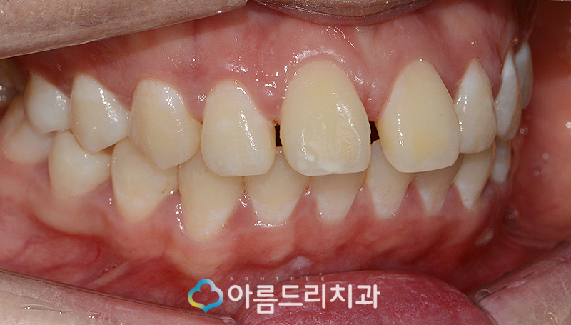 라미네이트부작용 걱정은노 관련 이미지 5