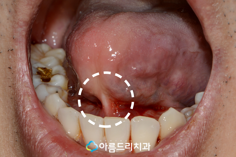 성인 설소대 수술 시술 완벽하게 관련 이미지 3