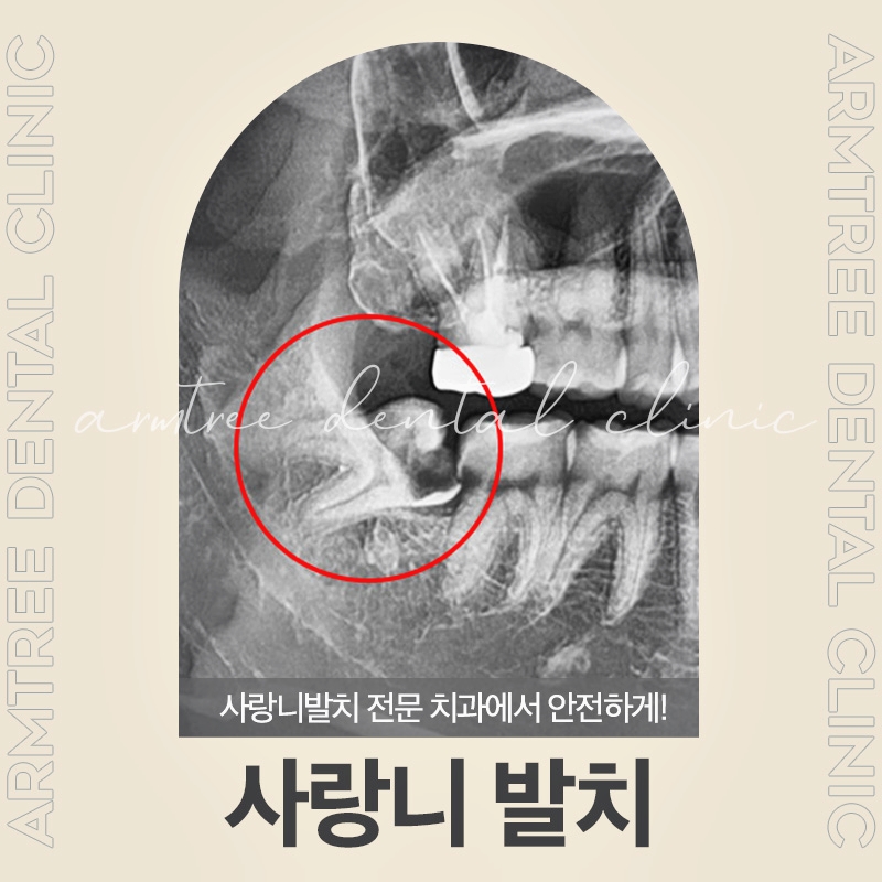 신논현역 사랑니발치는 체계적인 아름드리치과 관련 이미지 1