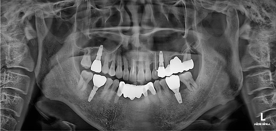 치아를 최대한 보존하는 임플란트 치료 관련 이미지 5