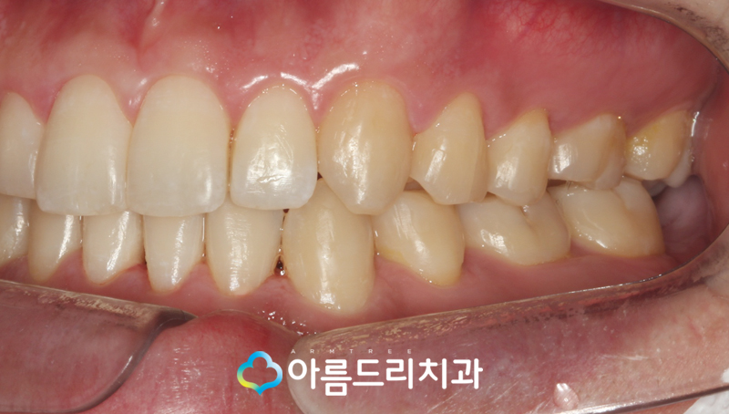 투명교정장치 인비절라인 치과 후기 관련 이미지 10