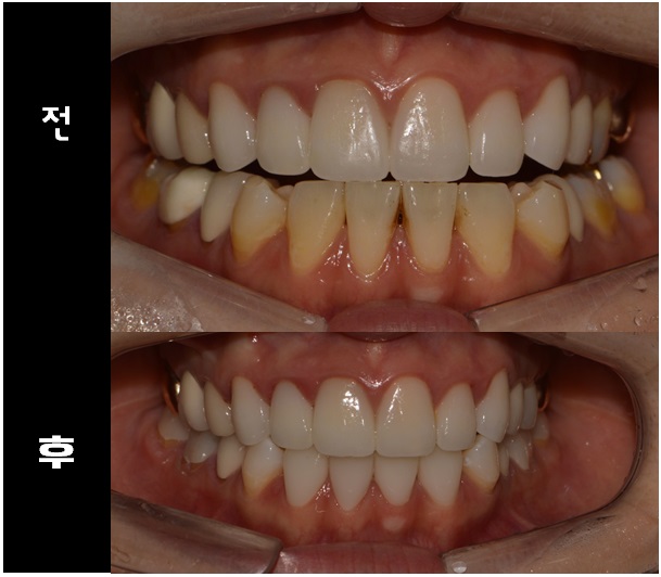 앞니 변색 _ 블랙 트라이앵글 #올 세라믹 관련 이미지 4