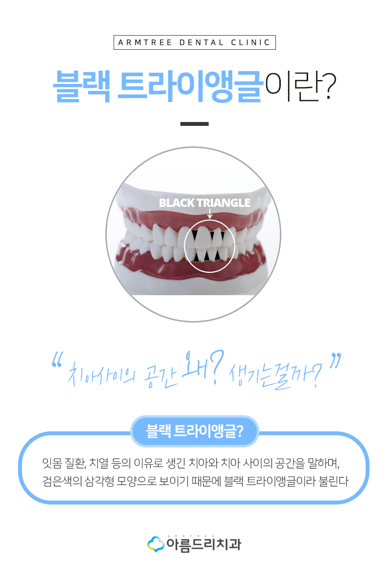 앞니블랙트라이앵글 치료 치아 후기 관련 이미지 6